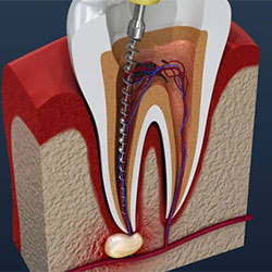 root canal rochester hills